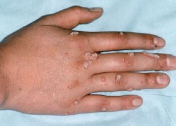 جدري القرود في اليونان